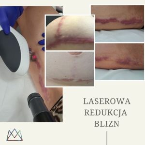 Laserowe usuwanie blizn Zielona Góra